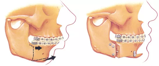 Maxillofacial Trauma